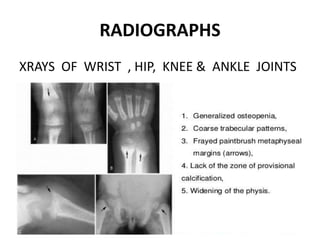 RICKETS | PPTX