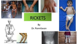 By
Dr. Ponnilavan
RICKETS
 