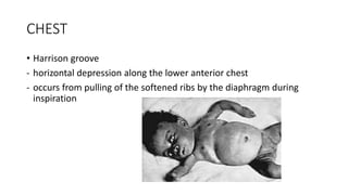 CHEST
• Harrison groove
- horizontal depression along the lower anterior chest
- occurs from pulling of the softened ribs by the diaphragm during
inspiration
 