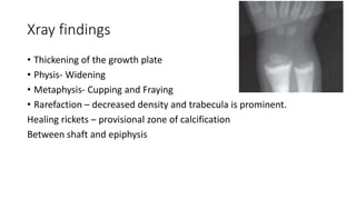 Xray findings
• Thickening of the growth plate
• Physis- Widening
• Metaphysis- Cupping and Fraying
• Rarefaction – decreased density and trabecula is prominent.
Healing rickets – provisional zone of calcification
Between shaft and epiphysis
 