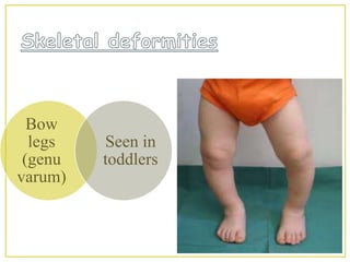 RICKETS | PPTX