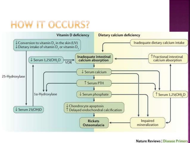 RICKETS clinical features | PPTX