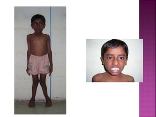 C Rickets RICKETS clinical features | PPTX