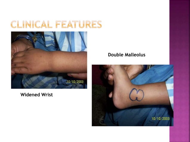 C Rickets RICKETS clinical features | PPTX