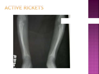 Blood Ph Rickets RICKETS clinical features | PPTX