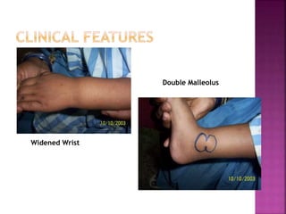 RICKETS clinical features | PPT