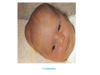 Craniotabes
 