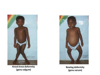 Knock knee deformity
(genu valgum)
Bowleg deformity
(genu varum)
 