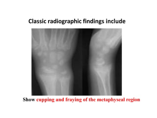 Classic radiographic findings include
Show cupping and fraying of the metaphyseal region
 
