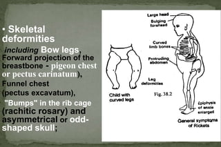 RICKETS .ppt