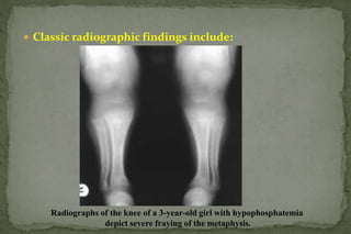 RICKETS .ppt