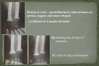 Article On Rickets RICKETS .ppt
