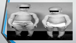 various types of rickets in pediatrics and its diagnosis and treatment.pptx