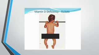 various types of rickets in pediatrics and its diagnosis and treatment.pptx