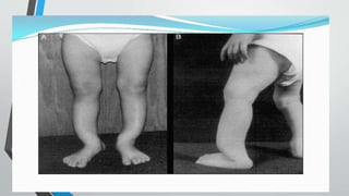 various types of rickets in pediatrics and its diagnosis and treatment.pptx