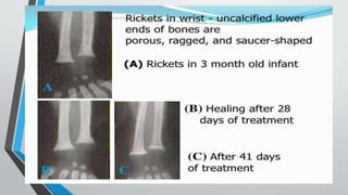 various types of rickets in pediatrics and its diagnosis and treatment.pptx