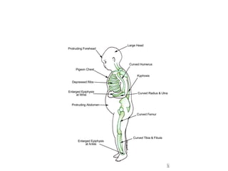 Rickets in Children PowerPoint Presentation.pptx