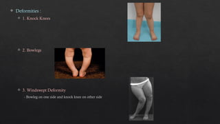 rickets 