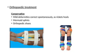 RICKETS : introduction, clinical features, Diagnosis, PT mangement | PPT