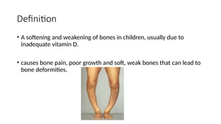 RICKETS : introduction, clinical features, Diagnosis, PT mangement | PPT