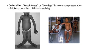 RICKETS : introduction, clinical features, Diagnosis, PT mangement | PPTX