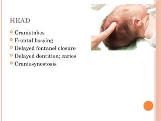 HEAD
 Craniotabes
 Frontal bossing
 Delayed fontanel closure
 Delayed dentition; caries
 Craniosynostosis
 