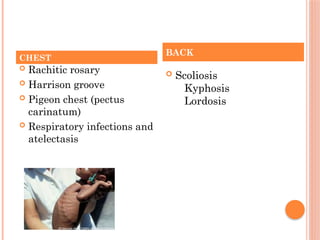  Rachitic rosary
 Harrison groove
 Pigeon chest (pectus
carinatum)
 Respiratory infections and
atelectasis
 Scoliosis
Kyphosis
Lordosis
CHEST
BACK
 