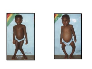 Rickets in children from diagnosis to treatment | PPTX