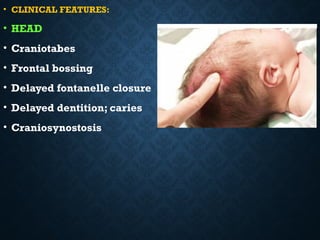 rickets management type prognosis causes | PPTX
