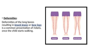 RICKETS manifestations of rocket and its management | PPTX
