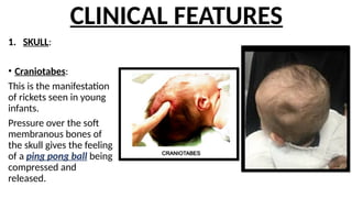RICKETS manifestations of rocket and its management | PPTX