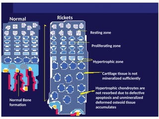 Rickets pathophysiology annd management. | PPTX
