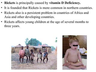 Modern issues about rickets in children. | PPT