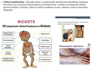 Child With Ricketa Modern issues about rickets in children. | PPT
