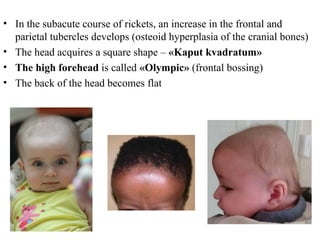 Head In Rickets Modern issues about rickets in children. | PPT