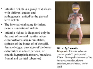 Modern issues about rickets in children. | PPT