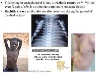 Modern issues about rickets in children. | PPT
