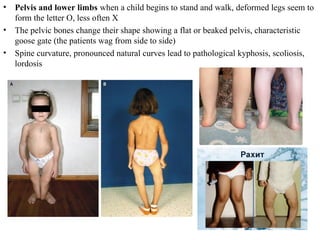 Modern issues about rickets in children. | PPT