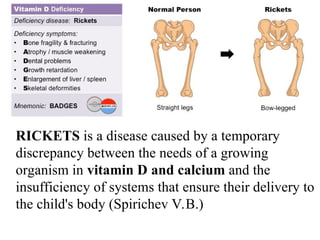 Rickets Overview Modern issues about rickets in children. | PPT