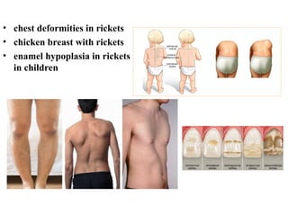 Child With Ricketa Modern issues about rickets in children. | PPT