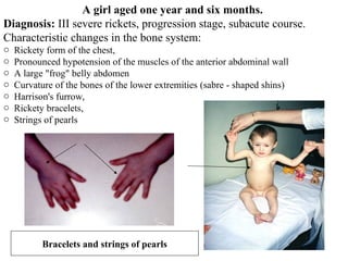 Modern issues about rickets in children. | PPT