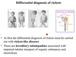 Table Rickets Differential Modern issues about rickets in children. | PPT