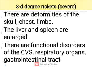 Comprehensive Overview of Rickets: Causes, Symptoms, and Treatment | PDF
