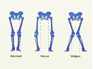 Rickets Overview Comprehensive Overview of Rickets: Causes, Diagnosis, and Treatment | PPTX