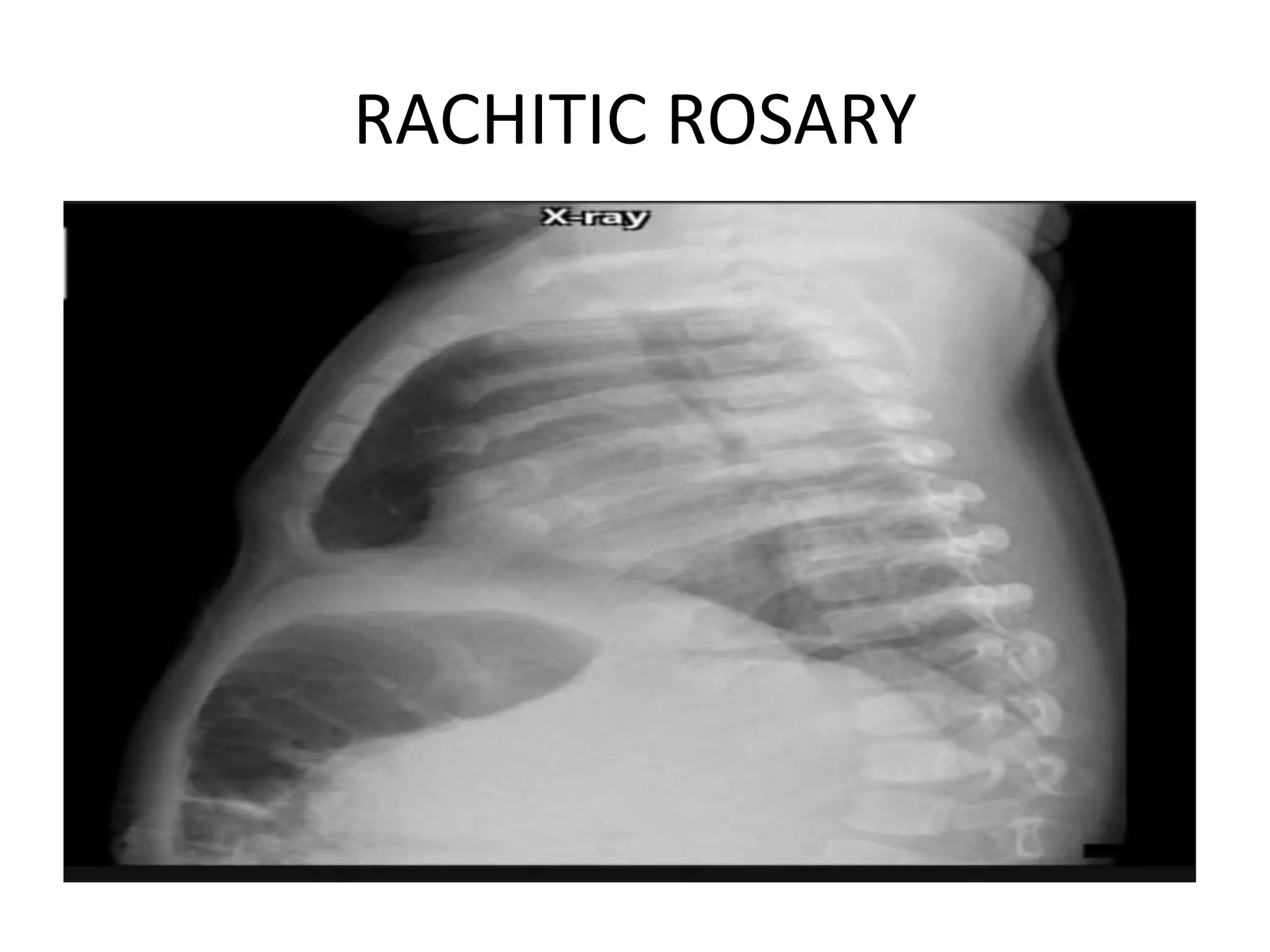 RICKETS -PPT.pptx