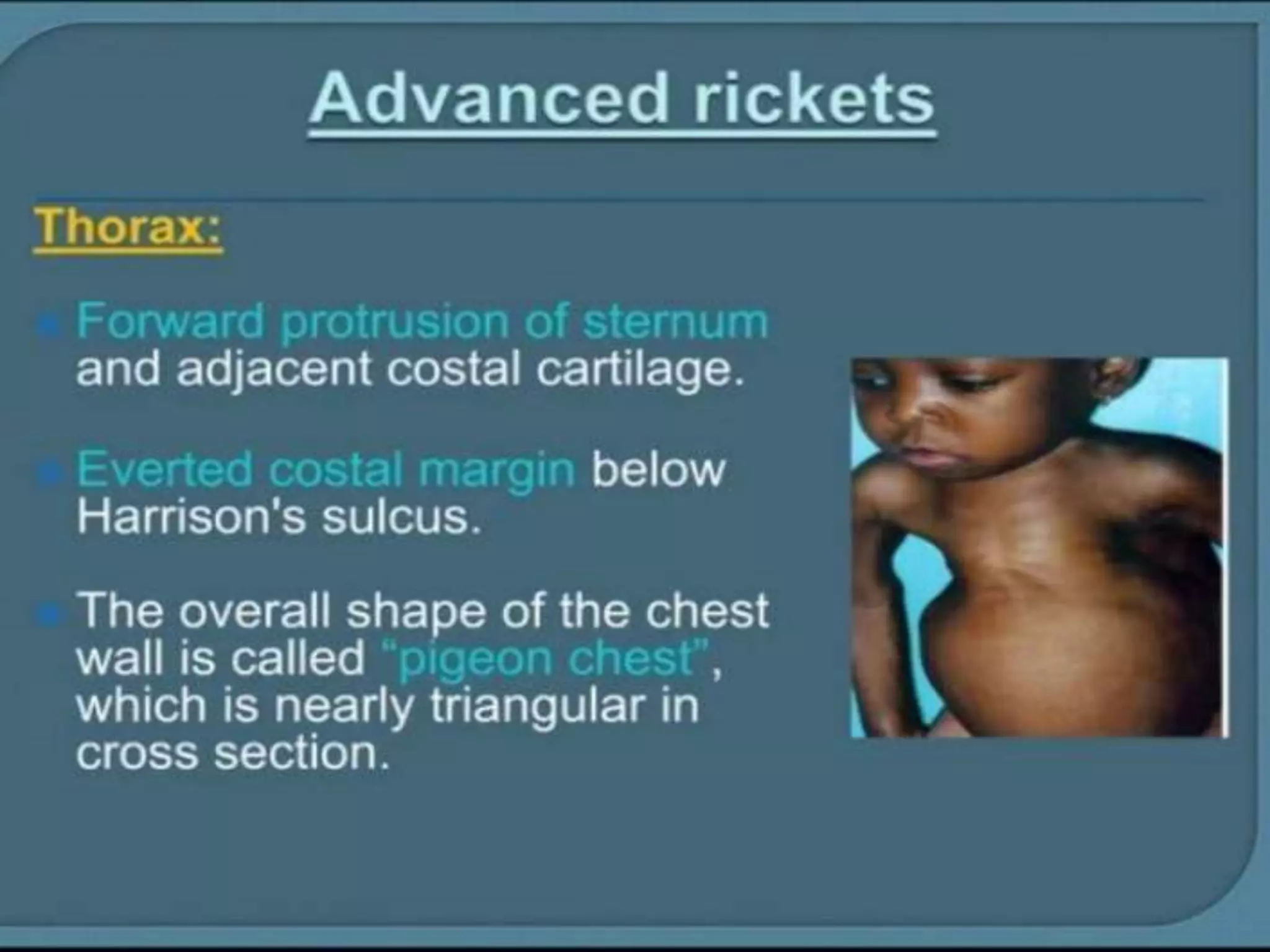 RICKETS -PPT.pptx