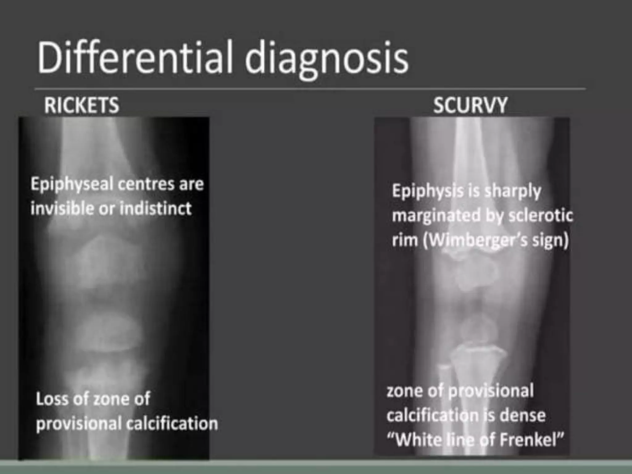 RICKETS -PPT.pptx