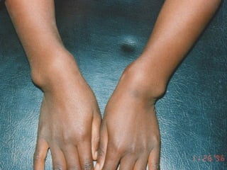 WWiiddeenniinngg ooff wwrriisstt jjooiinnttss 
 