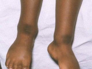 WWiiddeenniinngg ooff aannkkllee jjooiinnttss 
 