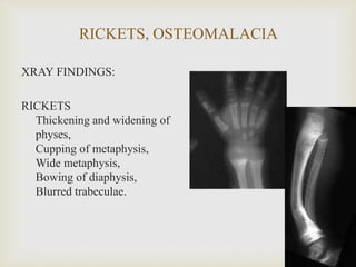 RICKETS, OSTEOMALACIA
XRAY FINDINGS:
RICKETS
Thickening and widening of
physes,
Cupping of metaphysis,
Wide metaphysis,
Bowing of diaphysis,
Blurred trabeculae.
 